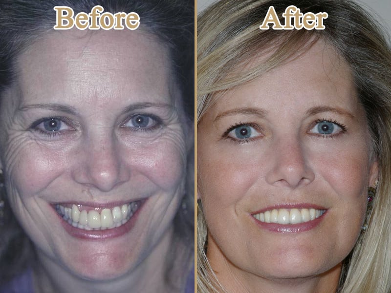 Porcelain Crown and Periodontal Plastic Surgery image on Huntingdon Valley Dental Arts