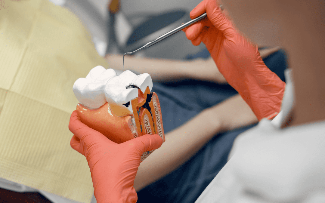 Why Taking Care of a Cavity Can Prevent The Need for Root Canal Therapy